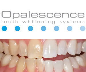 Opalescence Tooth Whitening